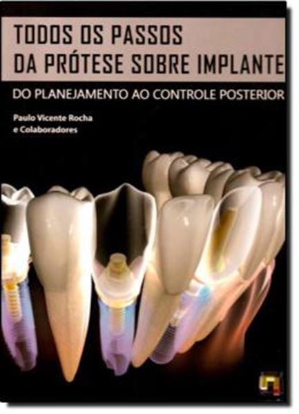 Picture of TODOS OS PASSOS DA PROTESE SOBRE IMPLANTE