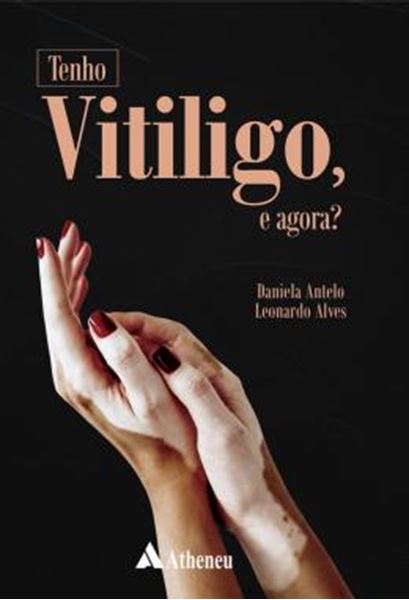 Picture of TENHO VITILIGO, E AGORA?