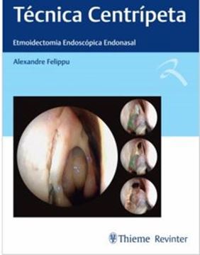 Imagem de TECNICA CENTRIPETA - ETMOIDECTOMIA ENDOSCOPICA ENDONASAL